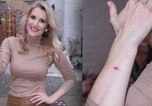 Moderátorka Lenka Špillarová se ošklivě popálila na ruce.
