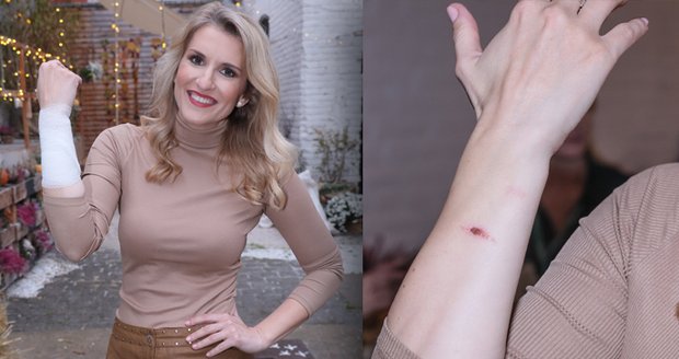 Moderátorka Lenka Špillarová se ošklivě popálila na ruce.