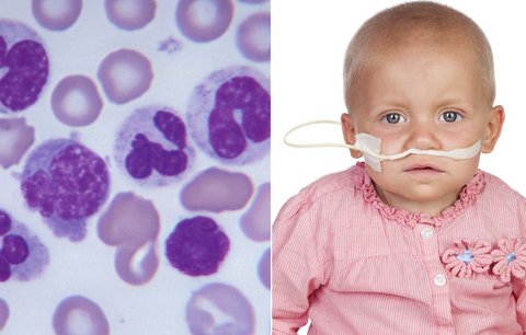 Čeští lékaři porazili rakovinu: Poprvé použili nový lék na leukémii