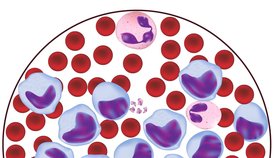 Rakovina krve s nemocnými buňkami