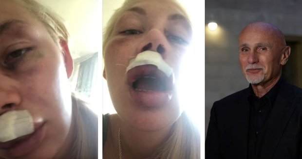 Napadená milenka mecenáše Motoristů Chlada: Důkazy jeho brutálního útoku!