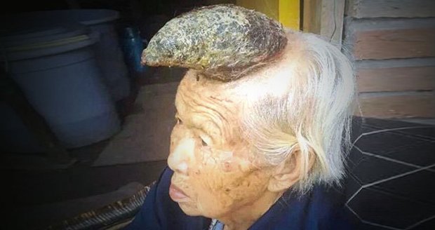 Číňance Liang Xiuzhen (87) vyrůstá z hlavy roh.