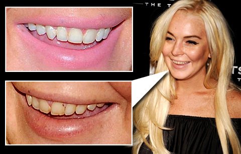 Dříve měla Lindsay zdravé zuby, nyní je má zničené a zažloutlé