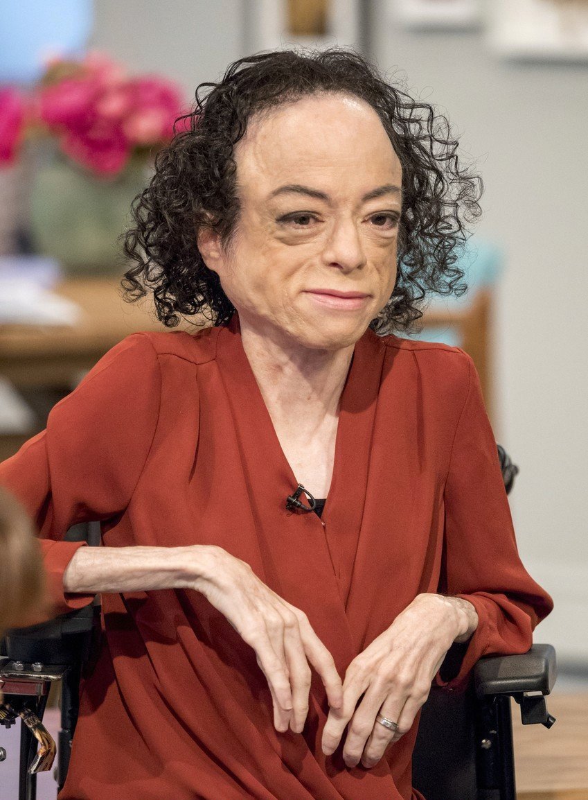 Liz Carr po napadení vtipkovala.