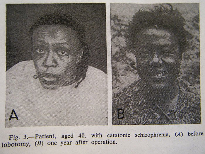 Pacienti před lobotomií a po ní, jak je prezentoval doktor Walter Freeman