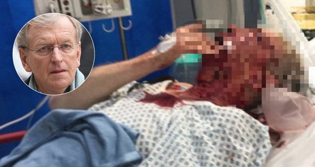 Exvelvyslance (74) zbili na ulici: Po brutálním útoku leží v nemocnici