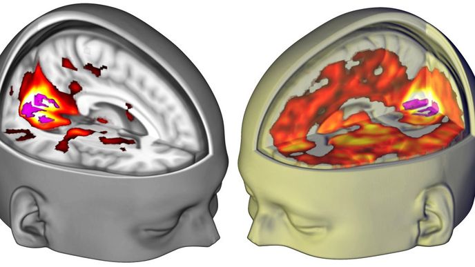 Vlevo placebo skupina, vpravo mozek na LSD