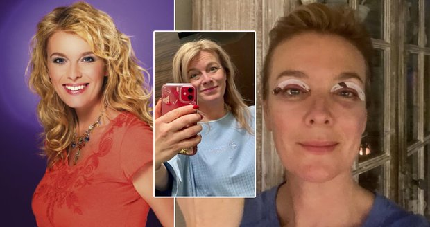 Lucie Benešová podstoupila plastiku víček.