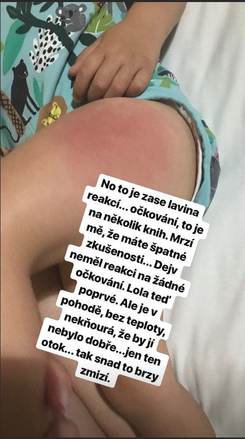 Ošklivá reakce na očkování na noze dcery Lucie Křížkové.