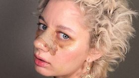 Po druhé léčbě rakoviny podstoupila Lucie Levá vytouženou plastiku nosu.