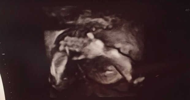 Lucie Šilhánová se pochlubila ultrazvukem miminka.