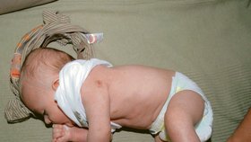 Očkovací látka na ručičce malého Ládíka vytvořila bolestivou ránu