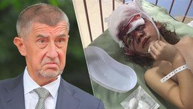 Andrej Babiš si všiml případu pokousané Lucinky.