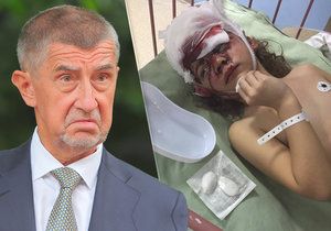 Andrej Babiš si všiml případu pokousané Lucinky.