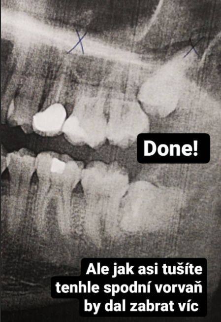 Lukáš Hejlík podstoupil dentistický zákrok