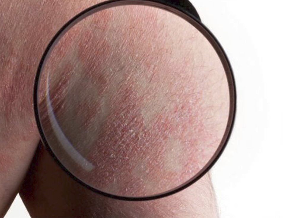 Bechtěrevova nemoc často způsobuje i kožní problémy, které jsou podobné lupence (ilustrační foto.)