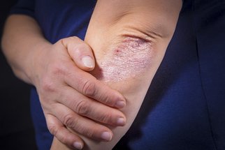 Psoriáza: Jak poznat počáteční příznaky lupénky? Psoriáza: Jak poznat počáteční příznaky lupénky?