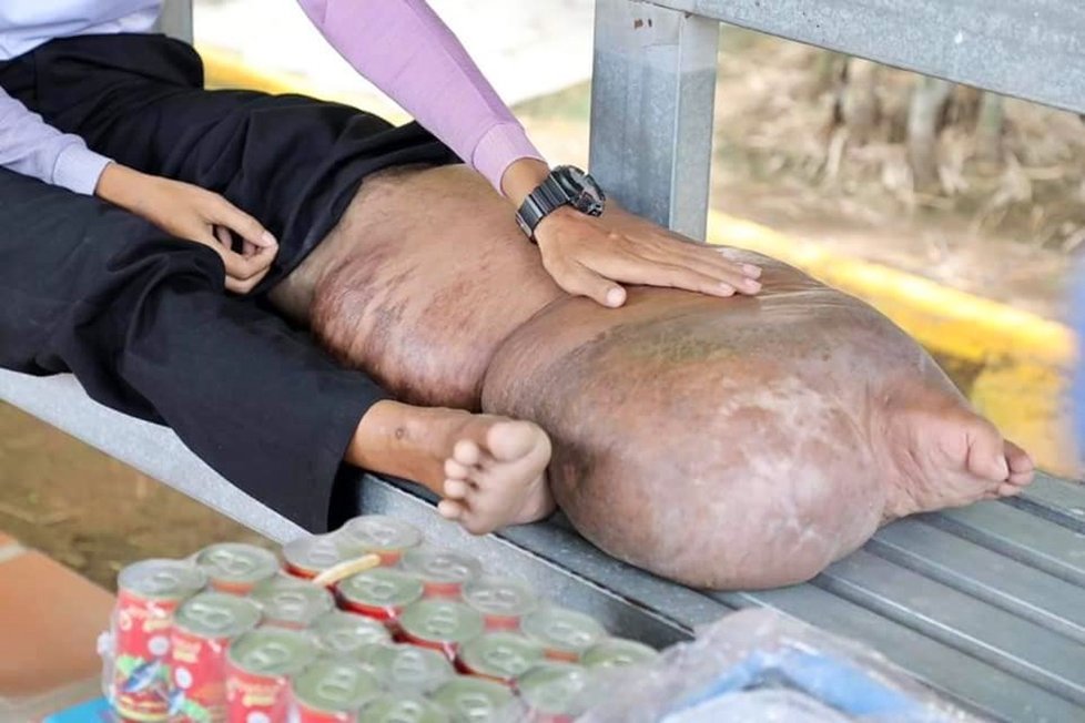 Infikovaný komár zničil mladému muži život: Jeho noha je pětkrát větší než normálně.