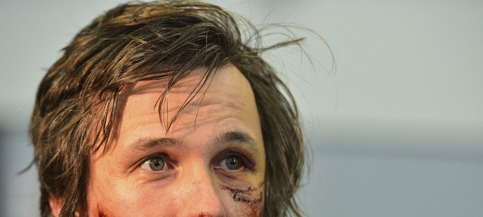 Ve tváři Ondřeje Banka jsou jasně znatelné krvavé rány, které utrpěl při vážném pádu na mistrovství světa