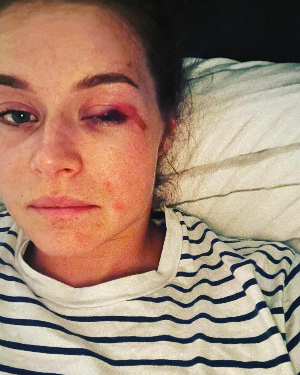 Švýcarská lyžařka Corinne Suterová má po pádu pořádně pohmožděné oko.