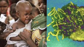 Nejméně 922 dětí a mladistvých zemřelo od října na Madagaskaru v důsledku spalniček, a to navzdory obrovskému vakcinačnímu programu. Oznámila to Světová zdravotnická organizace. (ilustrační foto)
