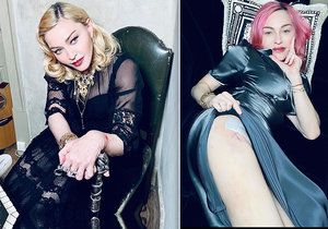Madonna se pochlubila jizvou! Má za sebou operaci?