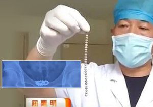 Muži z Číny si narval penisem do močového měchýře 29 magnetických korálků.