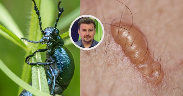 Rodiče malých dětí děsí jedovatý brouk: Puchýře, krev v moči, kóma? Entomolog vysvětluje!