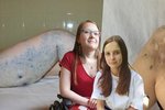Hana (17) a Aneta (16) trpí od dětství cévní malformací. Díky experimentální léčbě lékařů z Dětské nemocnice Brno se jejich stav výrazně zlepšil.