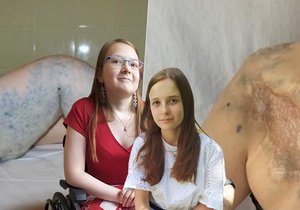 Hana (17) a Aneta (16) trpí od dětství cévní malformací. Díky experimentální léčbě lékařů z Dětské nemocnice Brno se jejich stav výrazně zlepšil.