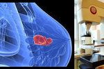 Nový mamograf, který umožňuje vyšetření prsu pomocí využití kontrastní látky, začali používat v Masarykově onkologickém ústavu v Brně.