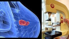 Nový mamograf v Brně: Rakovina v prsu svítí červeně