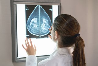 Zánětlivá rakovina prsu: Proč je její diagnostika obtížnější?