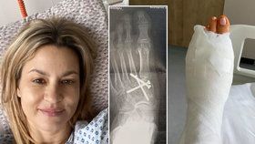 Monika Marešová znovu v nemocnici! Zlomený prst a šrouby v noze