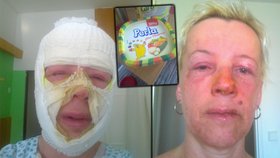 Ivu zranil obyčejný margarín: Po zahřátí jí explodoval do obličeje!