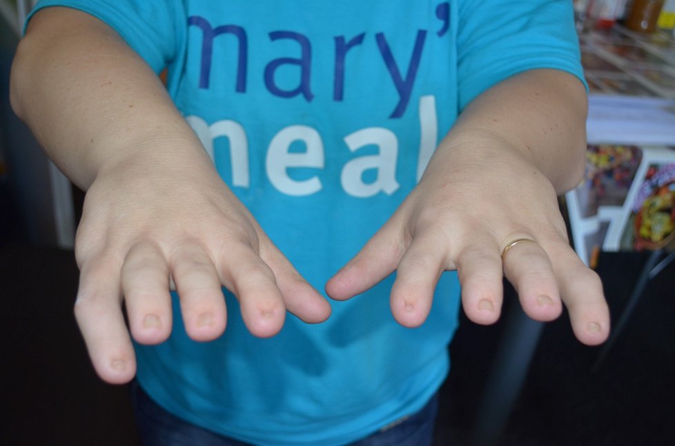 Maruška se narodila s 12 prsty, dva ji amputovali. Ruce má deformované, ale moc by si přála pracovat.