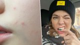 Marta Jandová prosí o radu: Jsou to neštovice, nebo ne?!