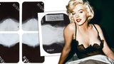 Tajemství krásy Marilyn Monroe? Rentgen odhalil zpackané plastiky!