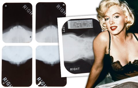 Tajemství krásy Marilyn Monroe? Rentgen odhalil zpackané plastiky!