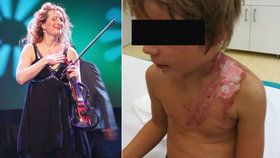 Popálený syn houslistky Muzikářové po transplantaci kůže: Ochranná trička a neustálé masírování jizev