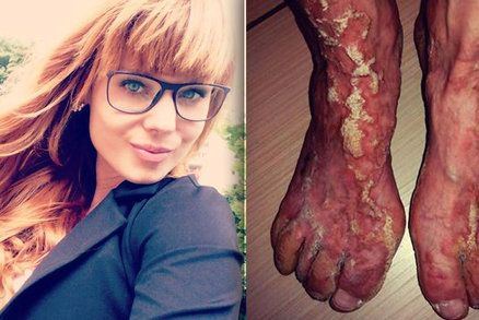 Maruška (23) bojuje s nevyléčitelnou nemocí kůže: Jediná v Česku trpí vzácnou formou Ichtyózy