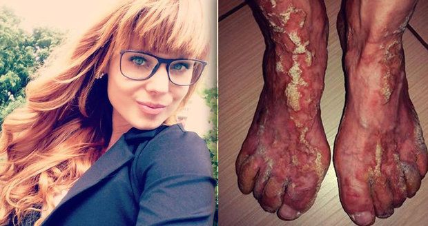 Maruška trpí vzácnou bolestivou nemocí kůže: Díky kampani pomůže desítkám stejně trpících dětí