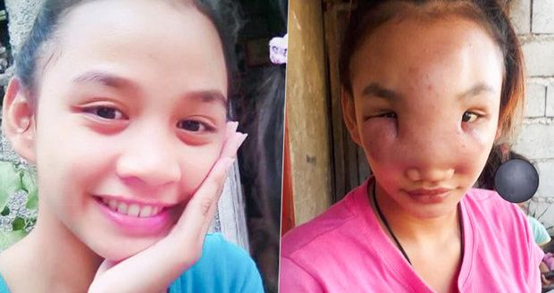 Dívka (17) si vymáčkla beďara, ze kterého se vyvinula záhadná nemoc: Oslepila ji!