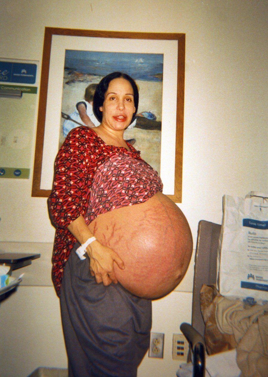 Oktomáma Nadya Sulemanová krátce před porodem