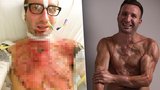 Sportovec dvakrát přežil svou smrt: Podruhé mu 14 tisíc voltů roztavilo kůži na těle