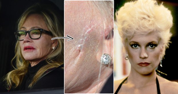Melanie Griffith předvedla jizvu na tvářo