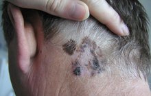 Melanomová abeceda: 5 znaků, že vám hrozí rakovina kůže