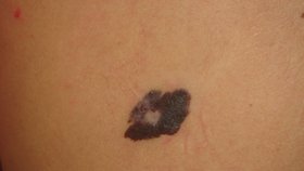 Melanom: Typický zhoubný melanom.