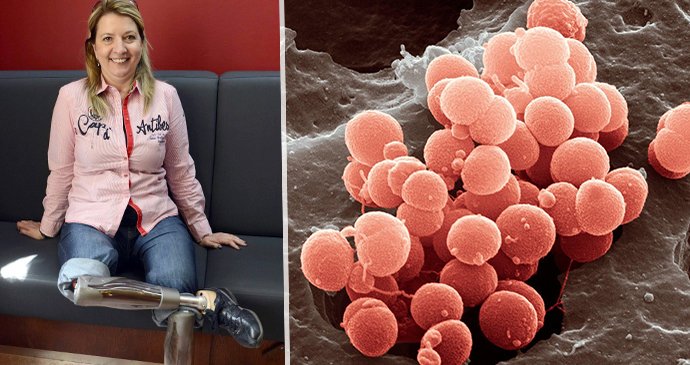 Andrea Brzobohatá (za ANO) před lety onemocněla meningitidou a lékaři jí museli amputovat dolní končetiny.