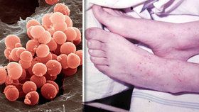 Po koronaviru hrozí dospívajícím infekční choroba: Spouštěčem může být i stres